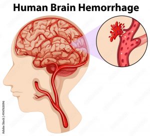 brain hemorrhage