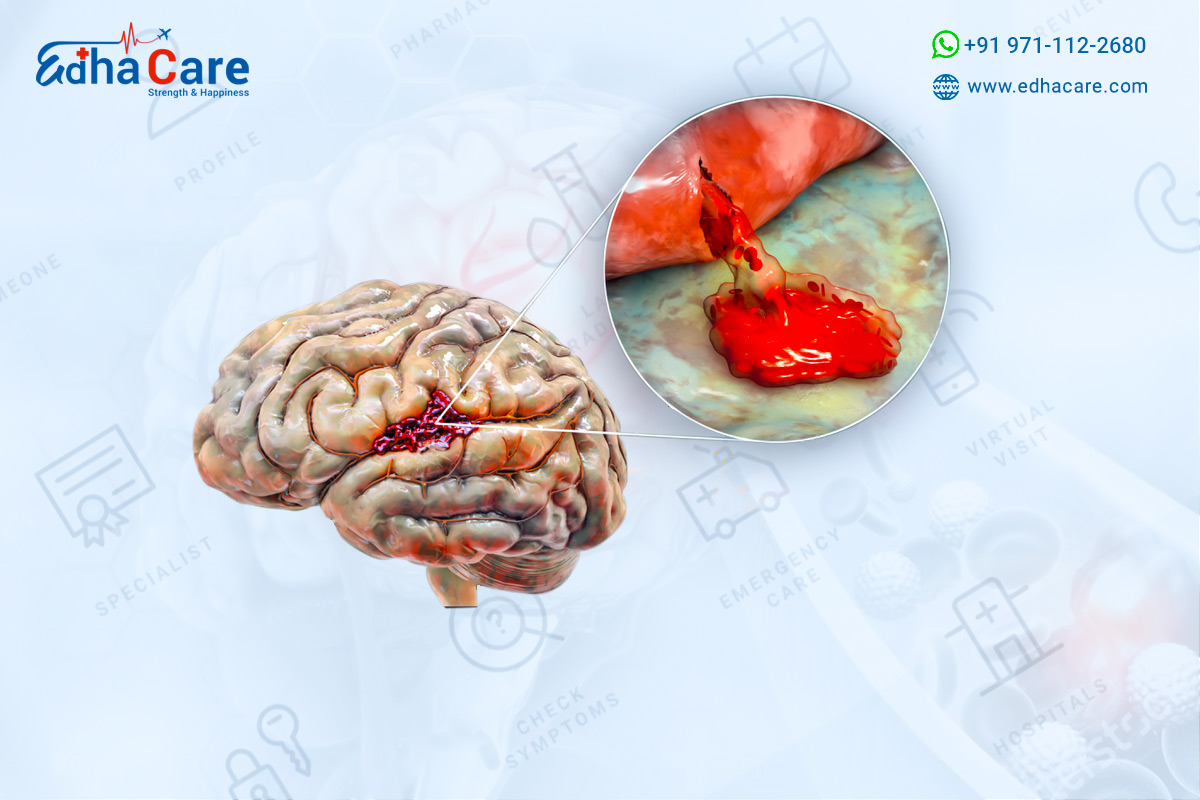 What is Brain Hemorrhage ? Causes & Treatment