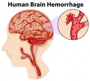 Hemorragia cerebral humana