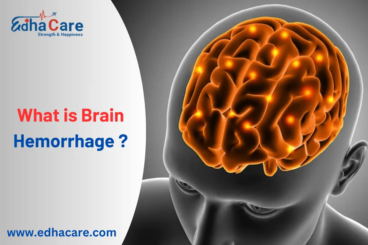 Was ist eine Gehirnblutung? Ursachen und Behandlung