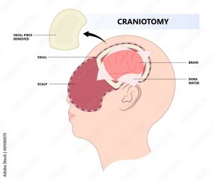 Cirurgia do tumor cerebral