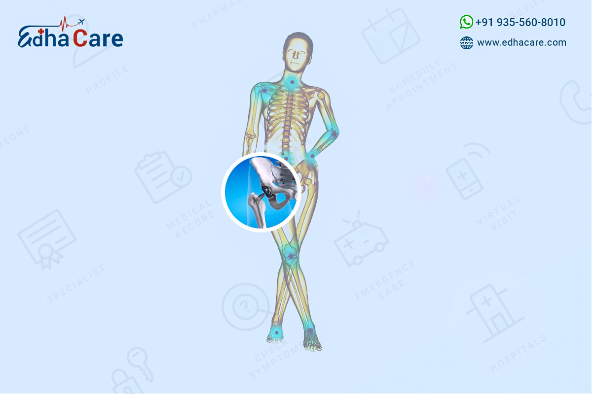 Hip Replacement Surgery In India