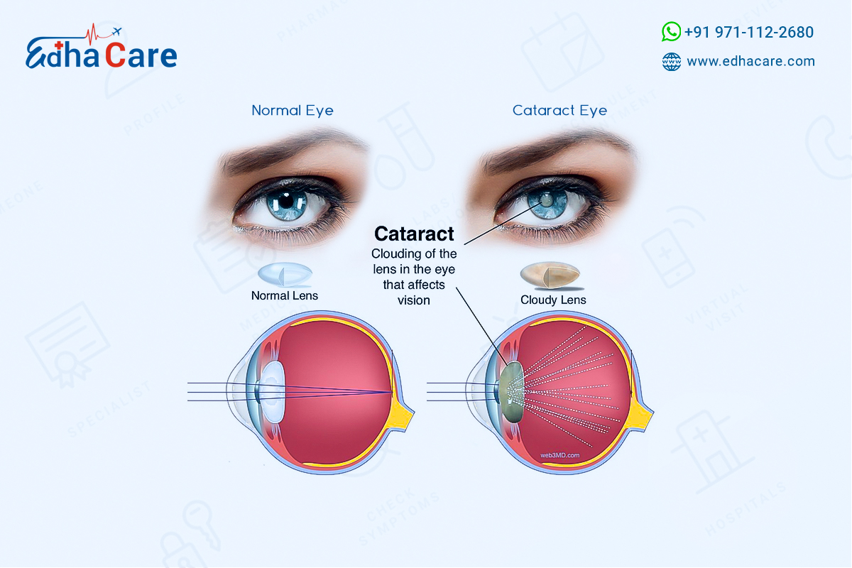 Cataract Surgery Cost In India