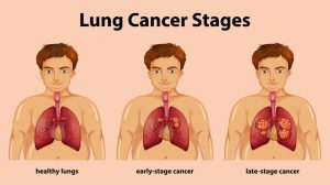cáncer de pulmón y de
