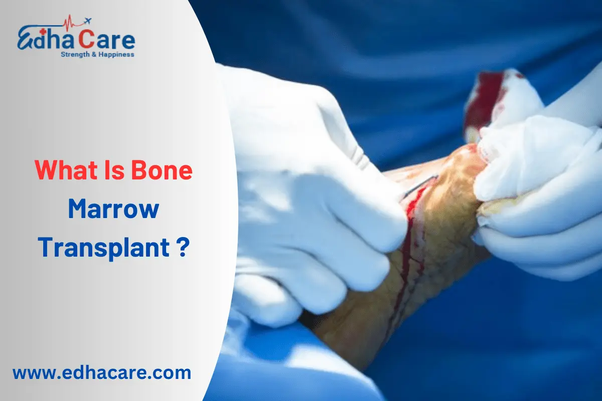 ¿Qué es el trasplante de médula ósea?