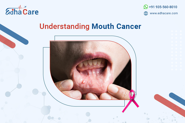 Understanding Mouth Cancer: Causes, Symptoms, and Diagnosis