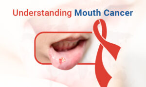 Understanding Mouth Cancer