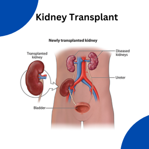 Kidney transplant price in India