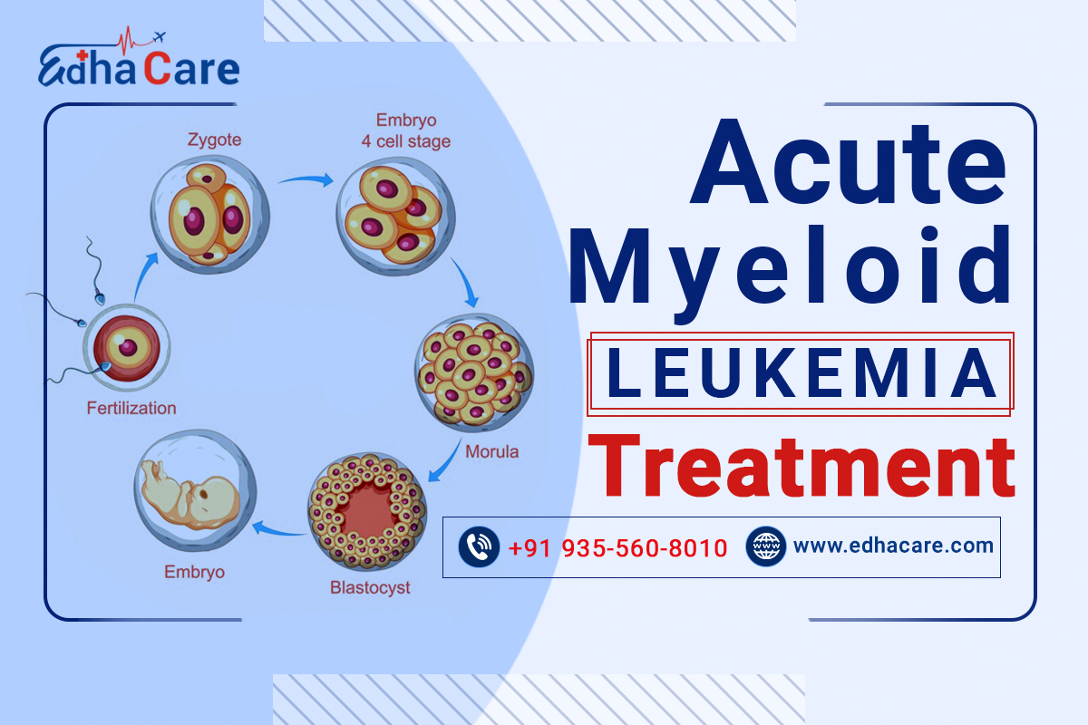 Acute Myeloid Leukemia Treatment