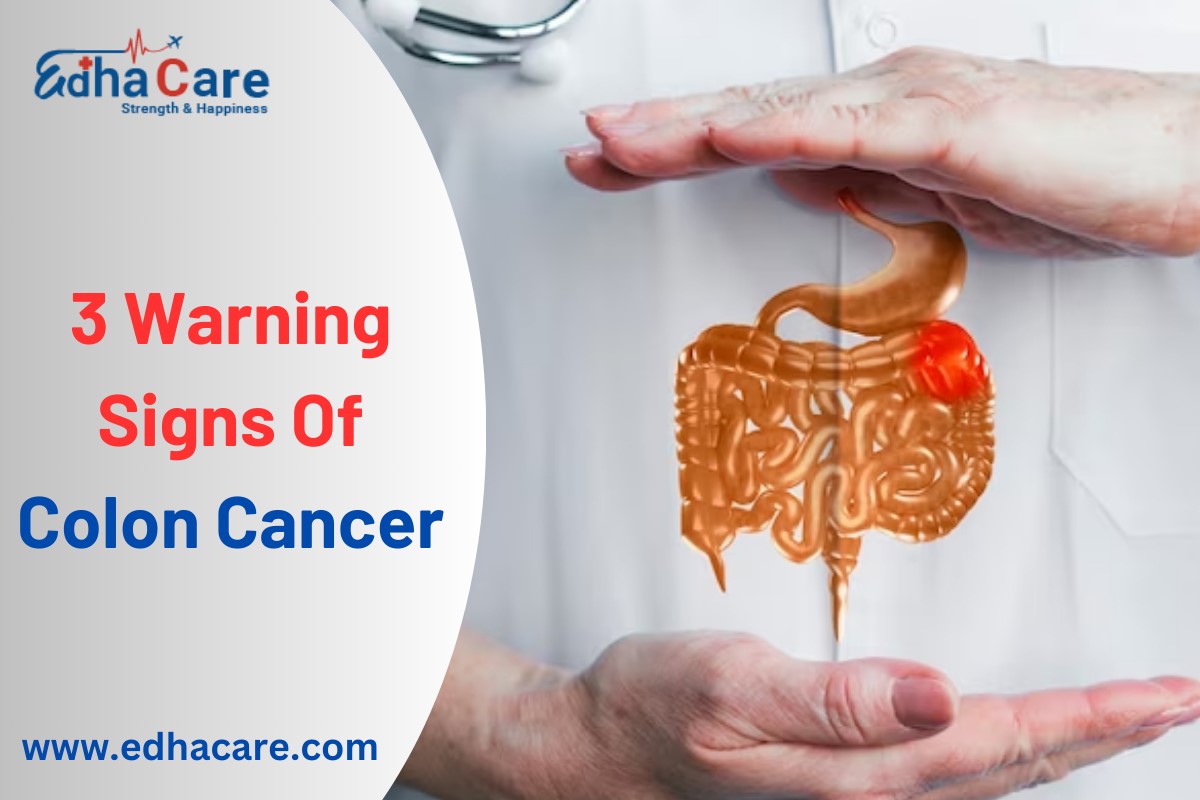 3 warning sings of colon cancer