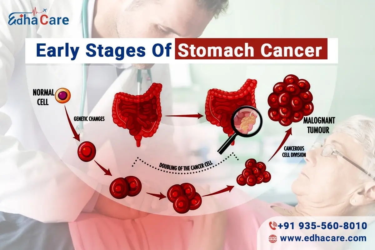 Premiers stades du cancer de l'estomac