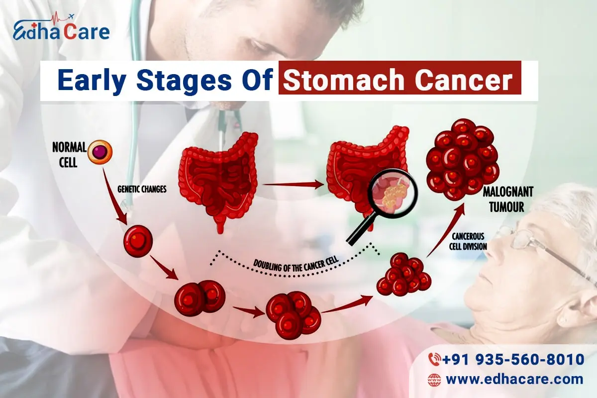 المراحل المبكرة من سرطان المعدة