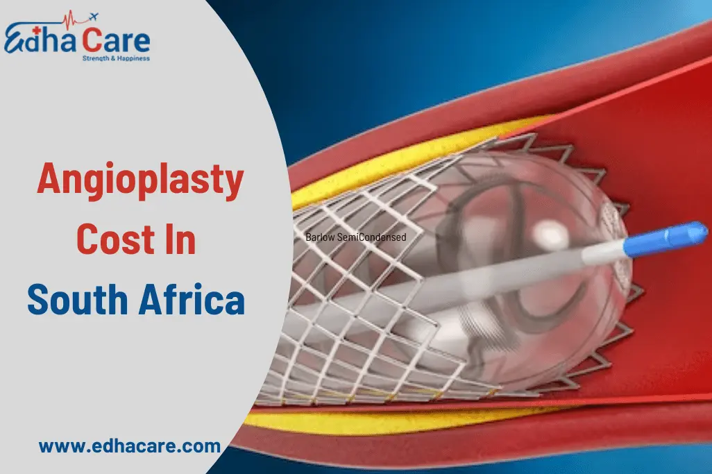 Coût de l'angioplastie en Afrique du Sud