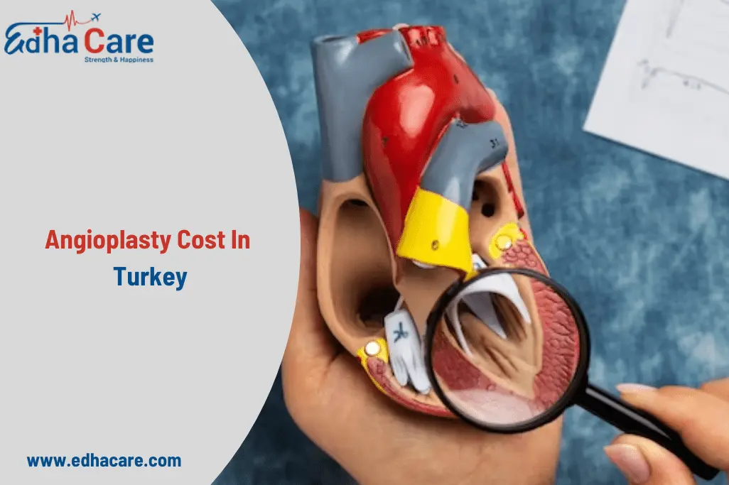 Angioplasty Cost in Turkey