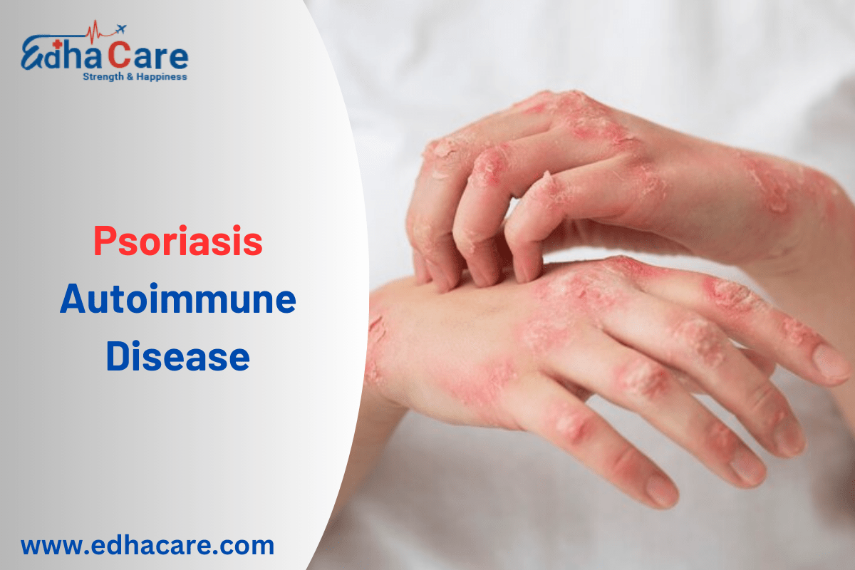 Ugonjwa wa Psoriasis Autoimmune