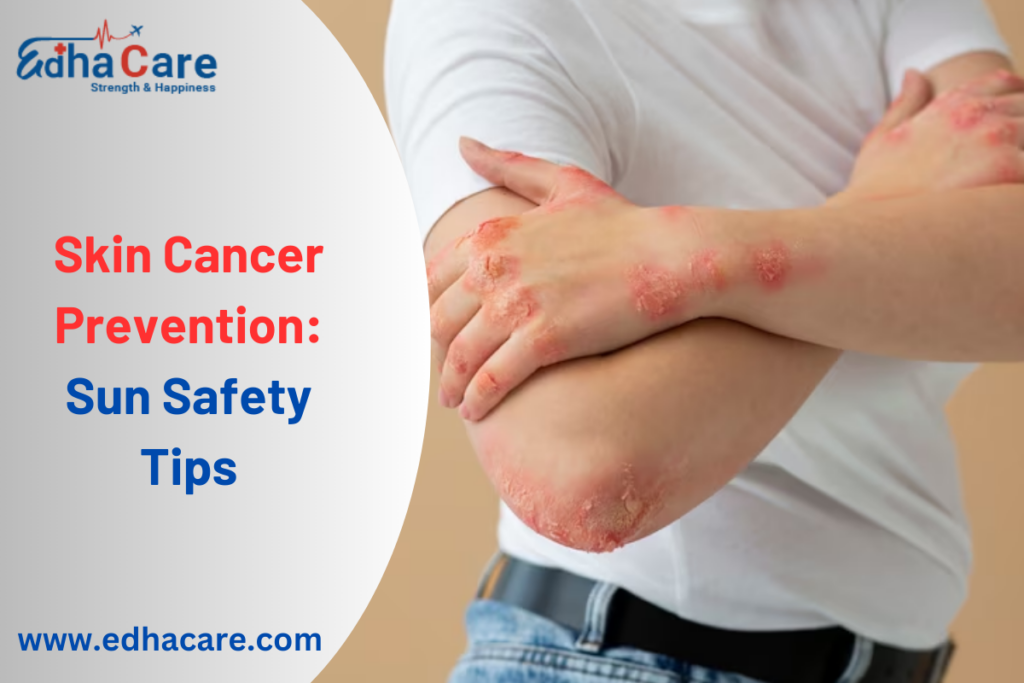 That Sunburn is not Good : Safety Tips for Skin Cancer