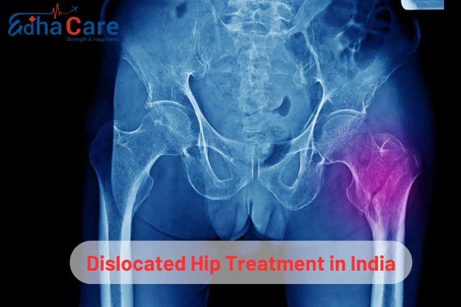 Advanced Dislocated Hip Treatment in India: Expert Care & Options