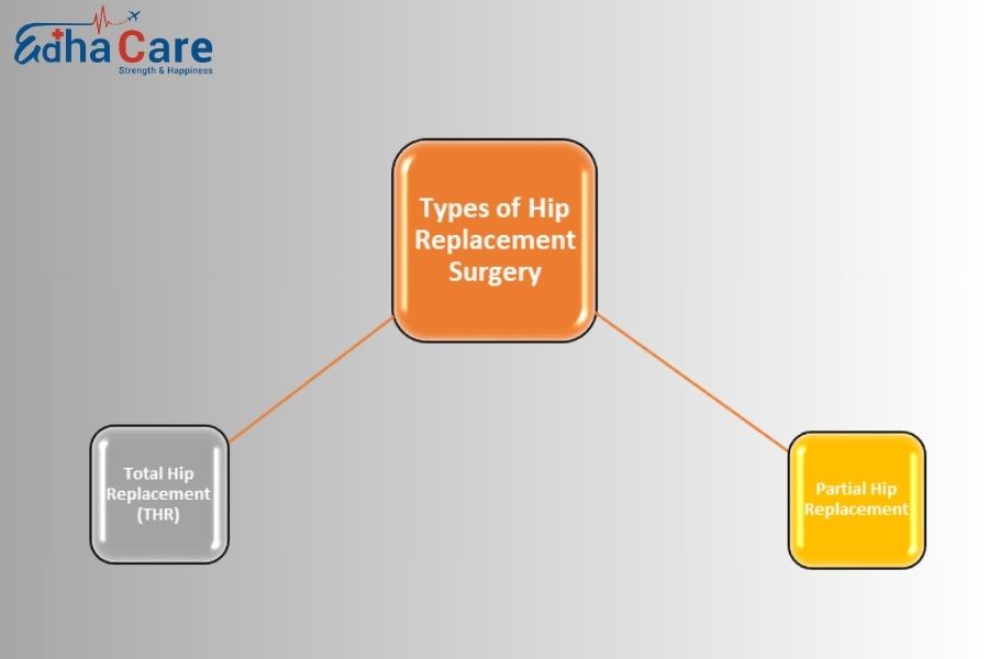 Types de chirurgie de remplacement de la hanche