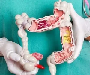 anal cancer diagnosis