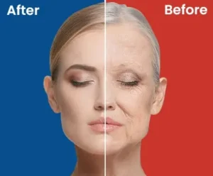 before and after blepharoplasty surgery in Turkey