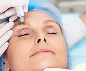 blepharoplasty in Turkey