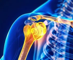 bone tumor risk factors