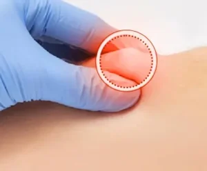 lipoma removal procedures