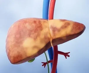 Liver transplant