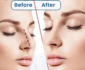 تكلفة عملية تجميل الأنف في تركيا قبل وبعد