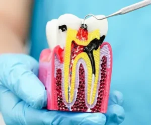 root canal treatment 