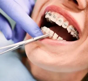 care of teeth braces
