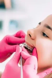 teeth braces