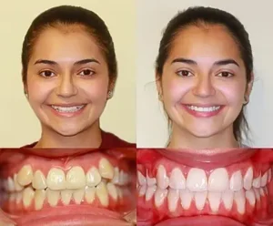 types of teeth braces