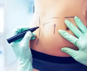liposuction surgery