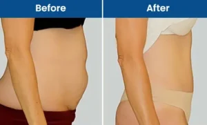 Liposuction Surgery Cost in Dubai – Complete Guide