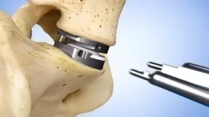 disc replacement surgery in India