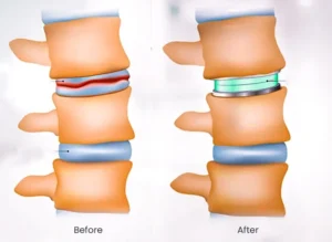 disc replacement surgery before and after