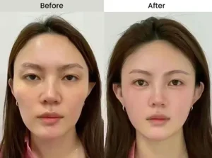 facelift in Thailand