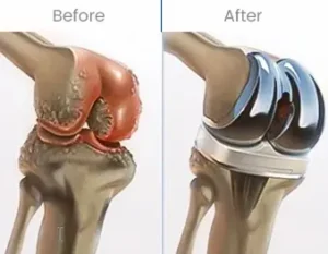 types of knee replacement surgery