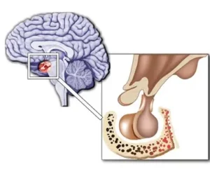 pituitary tumor treatment