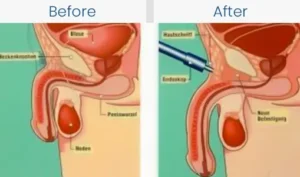 types of penis enlargement surgery