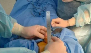 risks of penis enlargement surgery