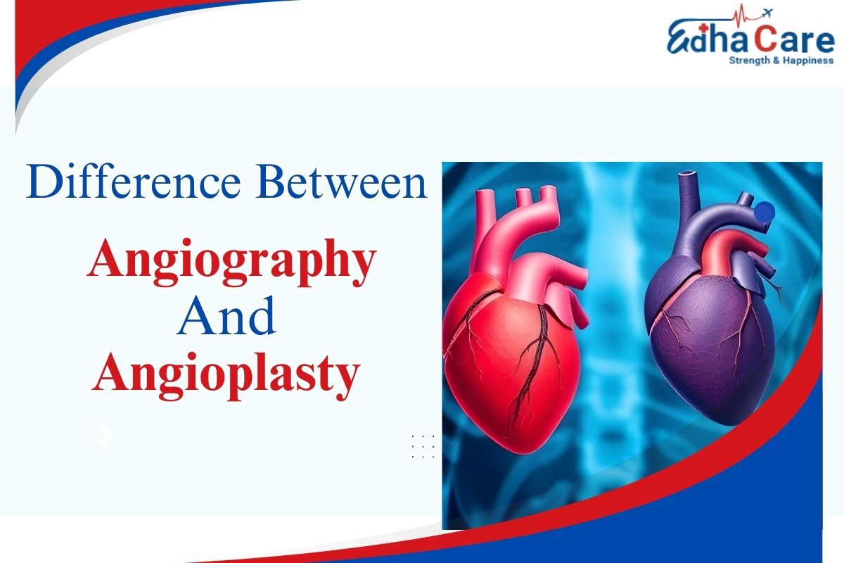 Diferencia entre angiografía y angioplastia