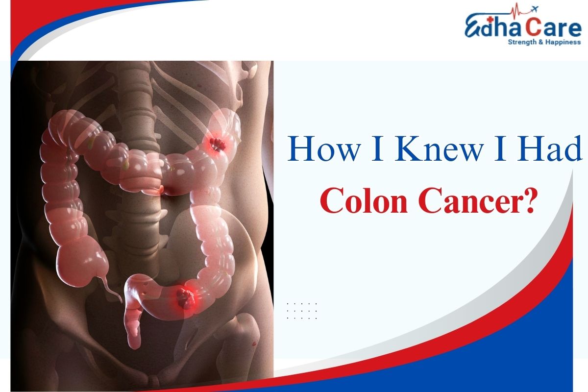 How I Knew I Had Colon Cancer?
