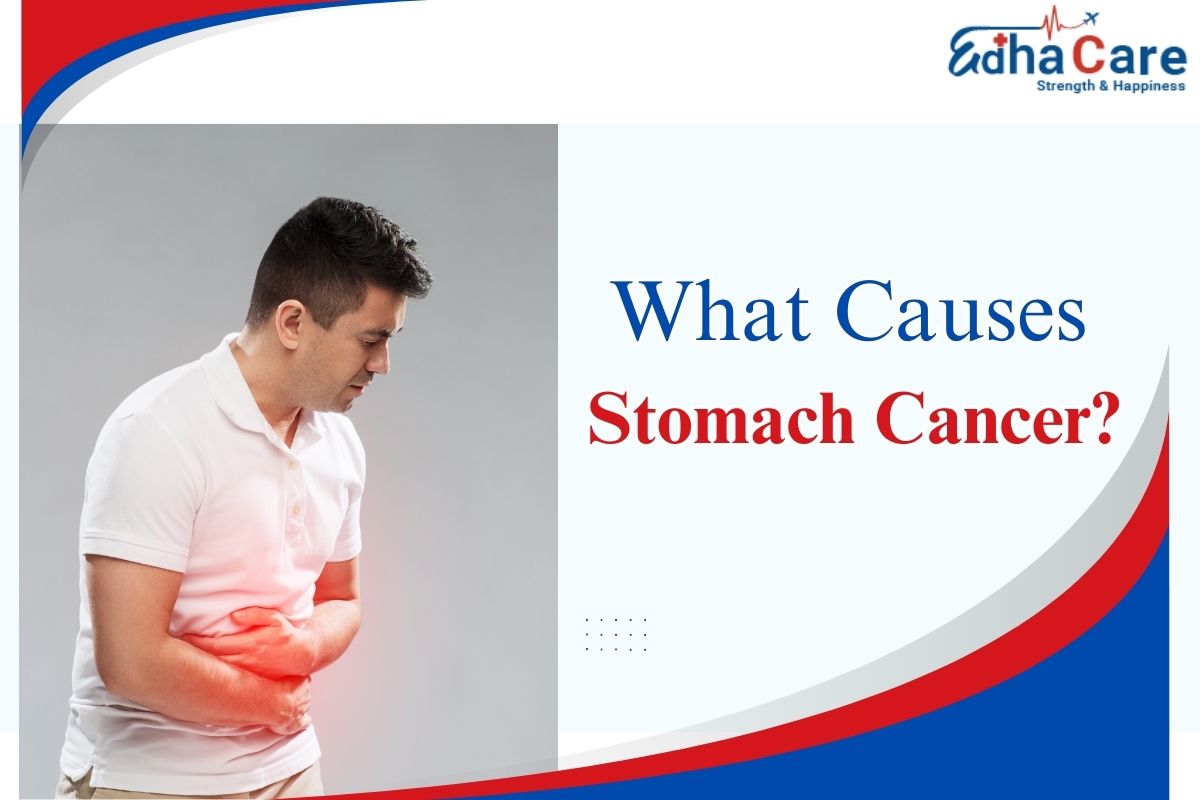 What Causes Stomach Cancer?