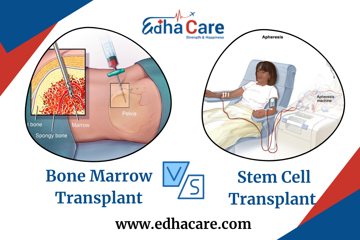 Bone Marrow Transplant Vs Stem Cell Transplant