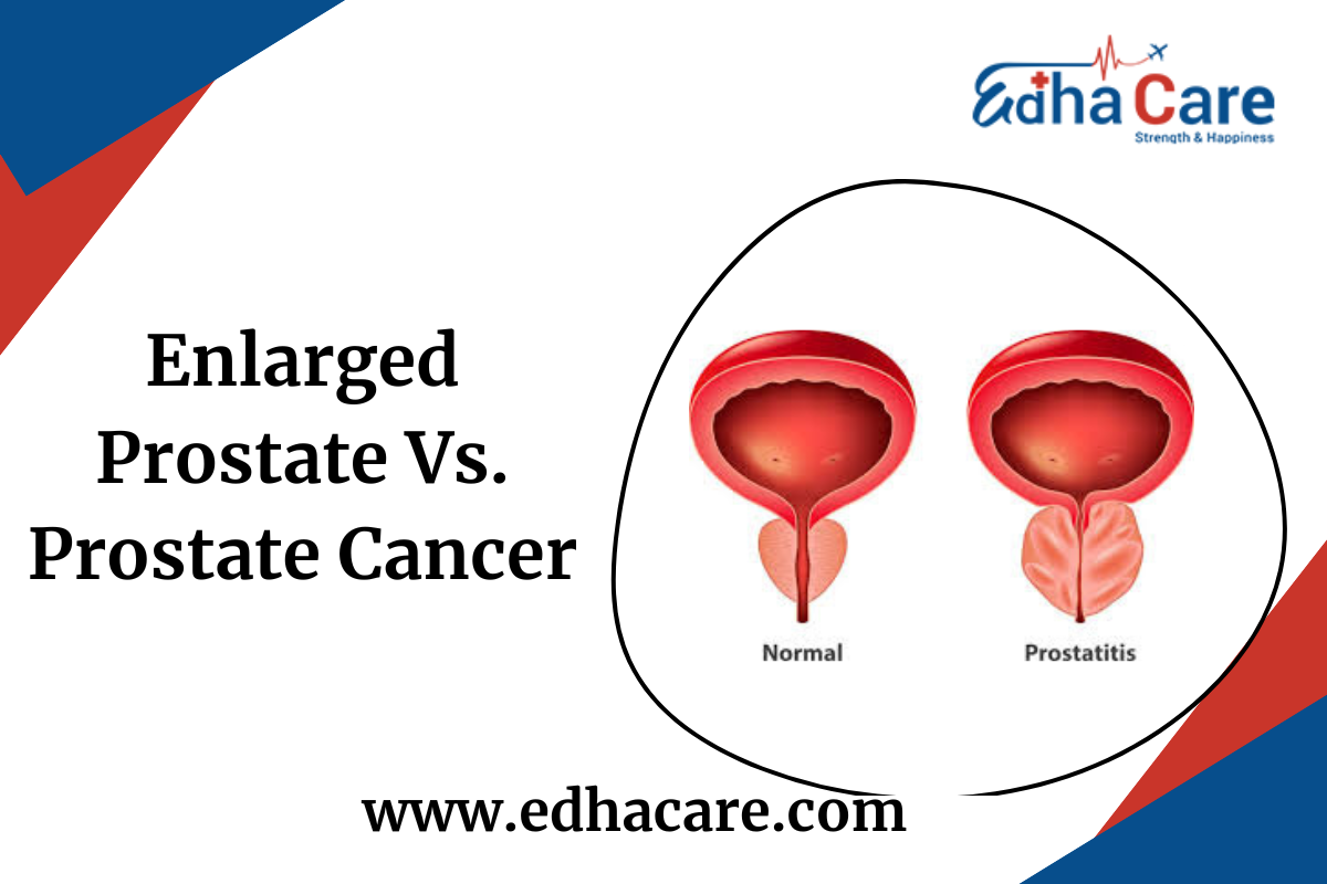 Enlarged Prostate Vs Prostate Cancer: What You Need to Know