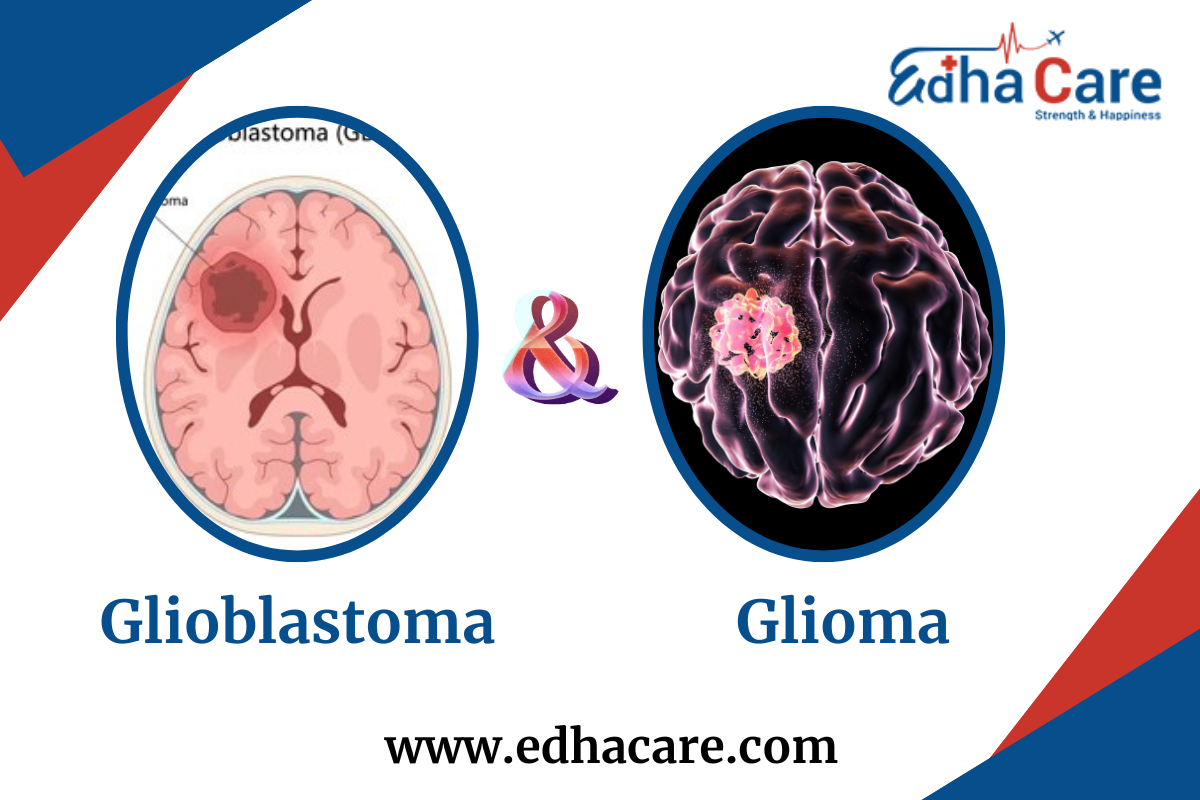 Are Glioma And Glioblastoma The Same Thing? Find Differences