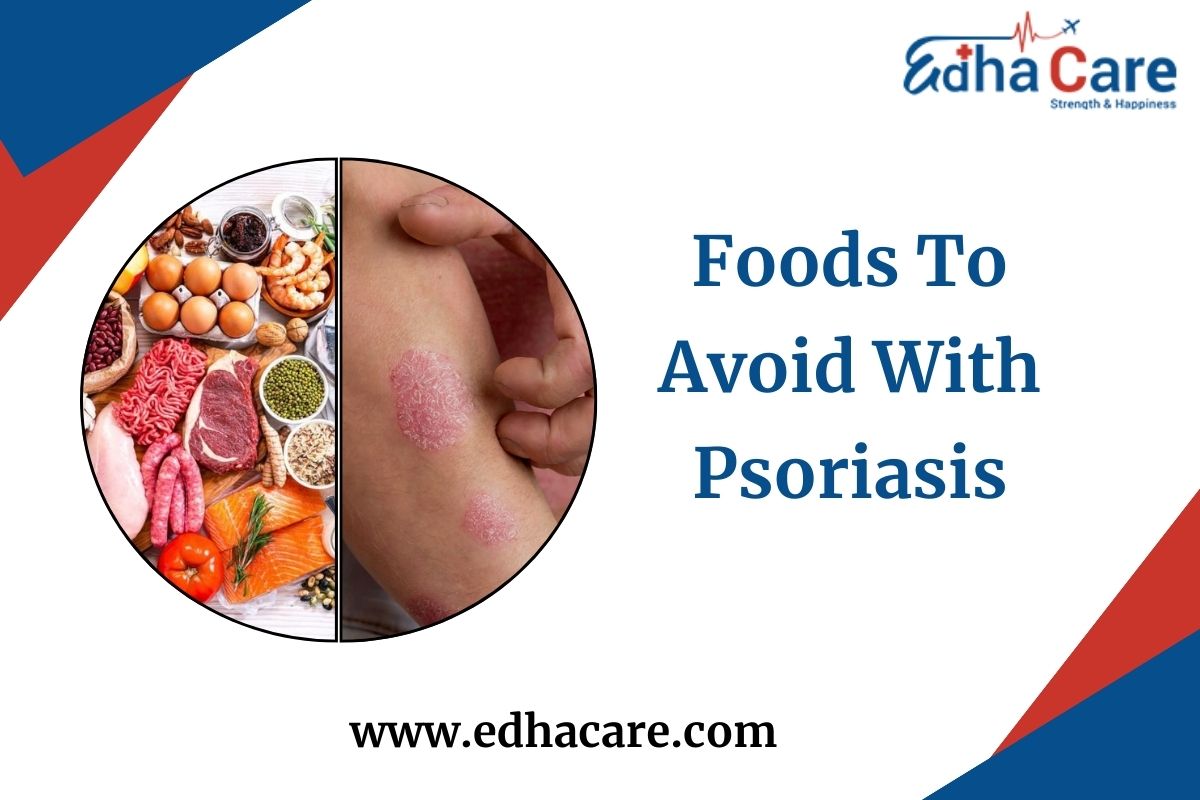 9 Foods To Avoid With Psoriasis: Diet For Psoriasis