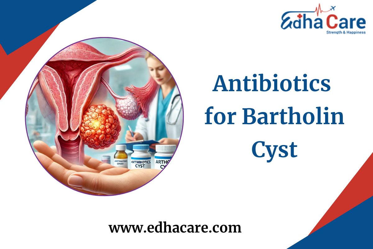 Antibiotics for Bartholin Cyst: When Are They Necessary?